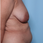 Mommy Makeover Before & After Patient #34313
